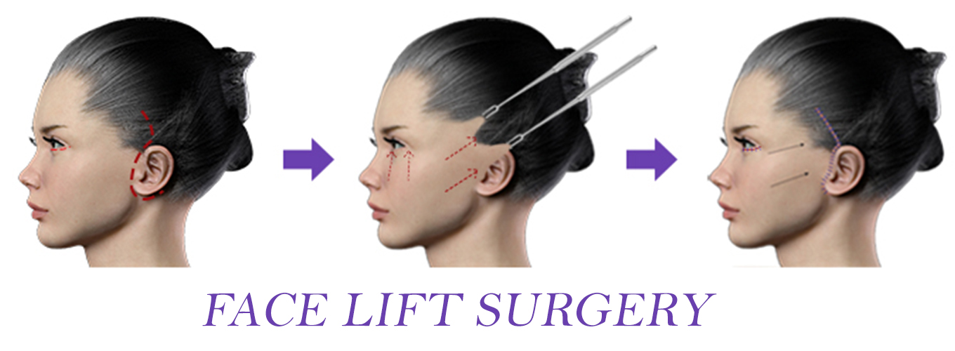 FACE LIFT SURGERY​