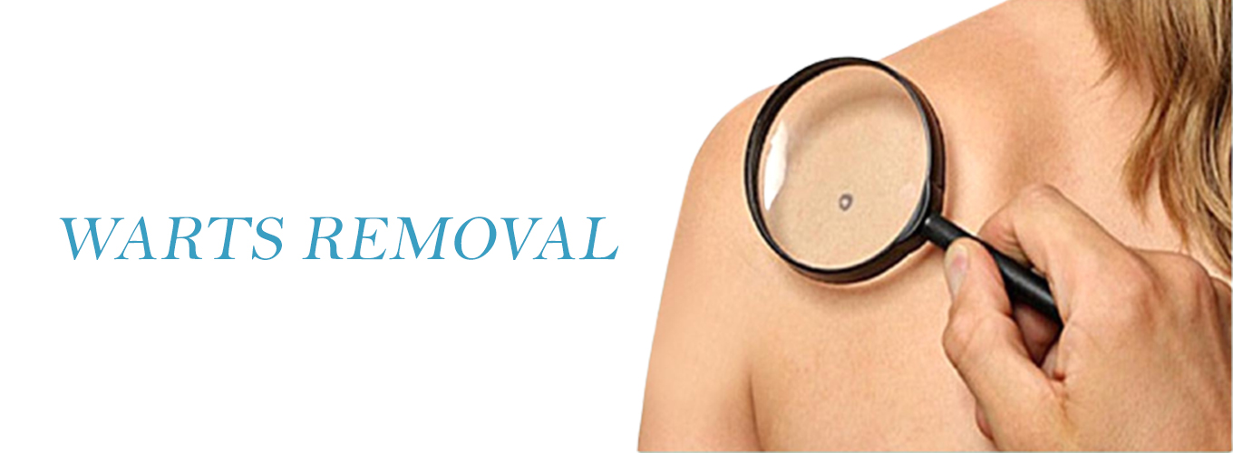 WARTS-REMOVAL-1 WARTS REMOVAL