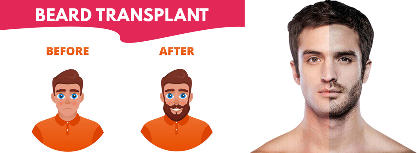 beard transplant
