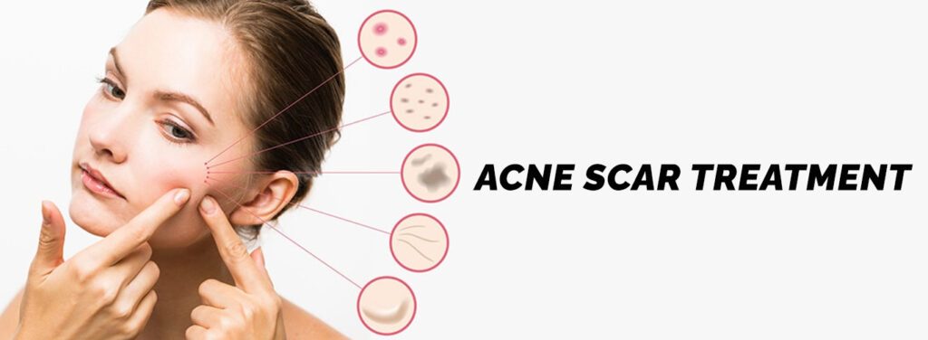 Acne Scar Treatment in Gurgaon